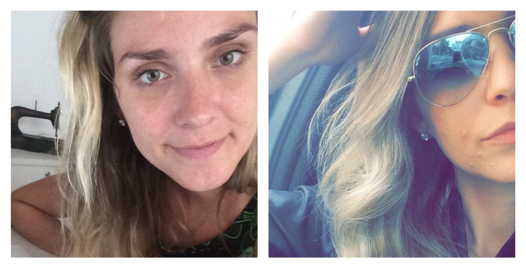 Lado esq. - Em Dezembro/15 Pós Tratamento. Lad Dir. em Maio/16 Pós Descuido